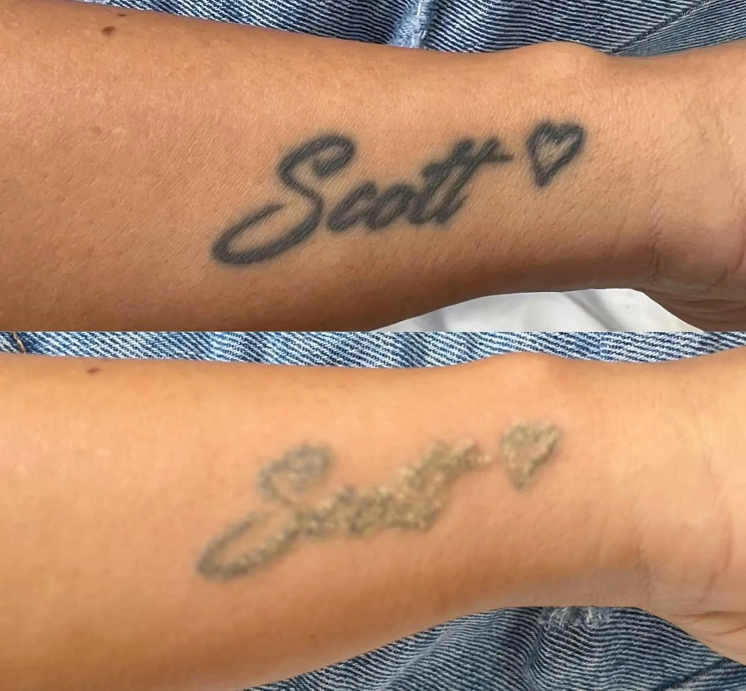 Hair Removal | Safe Tattoo Removal: Saline vs. Laser Options in Melbourne Hair Removal | Safe Tattoo Removal: Saline vs. Laser Options in Melbourne