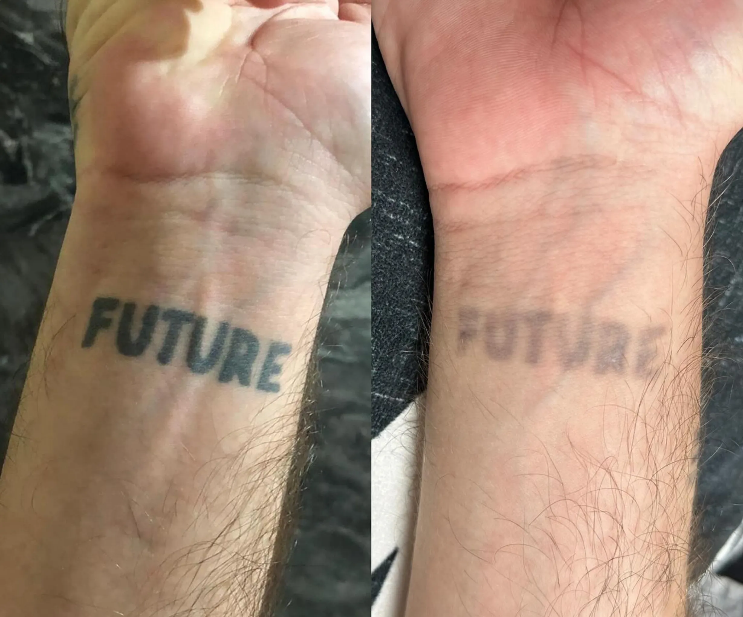 Hair Removal | Safe Tattoo Removal: Saline vs. Laser Options in Melbourne Hair Removal | Safe Tattoo Removal: Saline vs. Laser Options in Melbourne